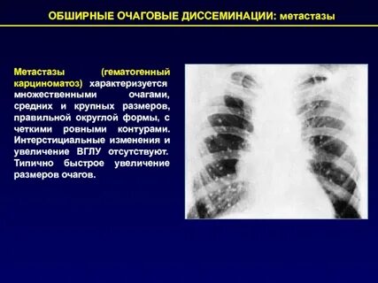 Множественного очагового