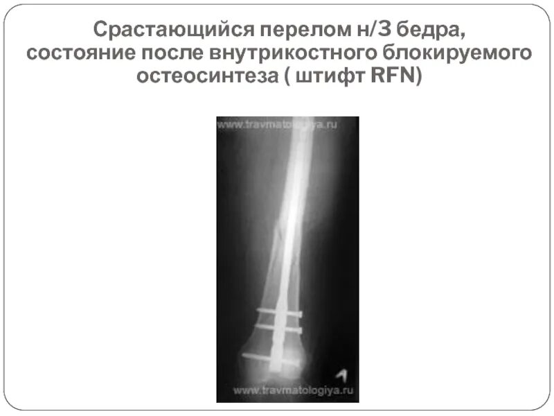 Перелом н/3 бедренной кости. Неправильно сросшийся перелом бедренной кости. Неправильное срастание перелома бедренной кости.