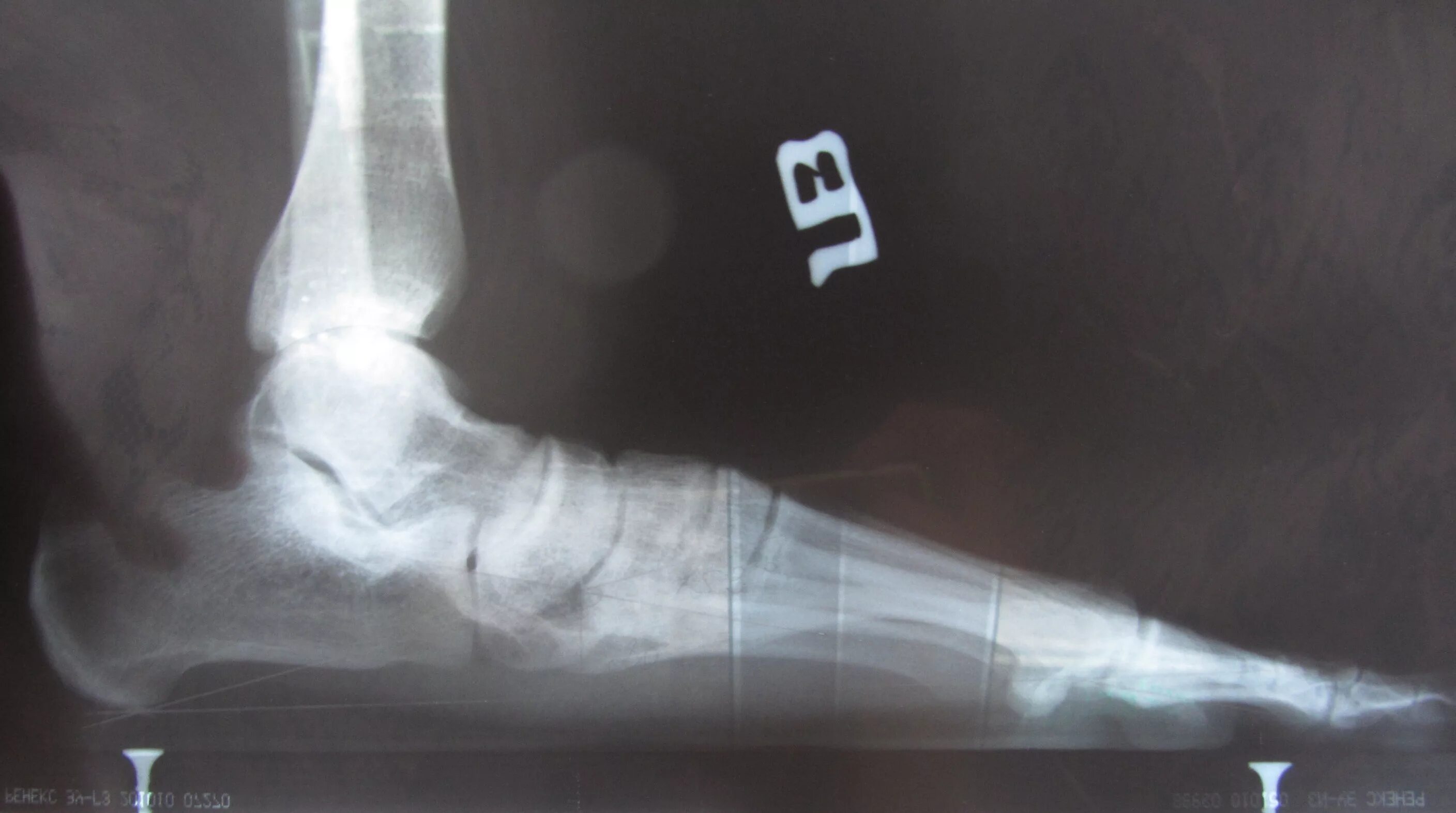 рентген стопы плоскостопие 2 степени. продольное плоскостопие рентген.