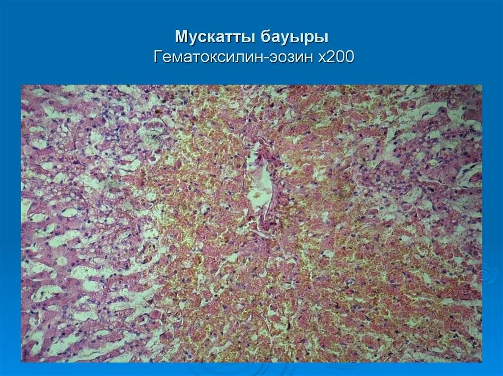 Печень при хроническом венозном застое. Венозное полнокровие печени мускатная печень. Мускатная печень микропрепарат гематоксилин эозин. Венозное полнокровие печени гистология. Препарат венозное полнокровие печени мускатная печень.