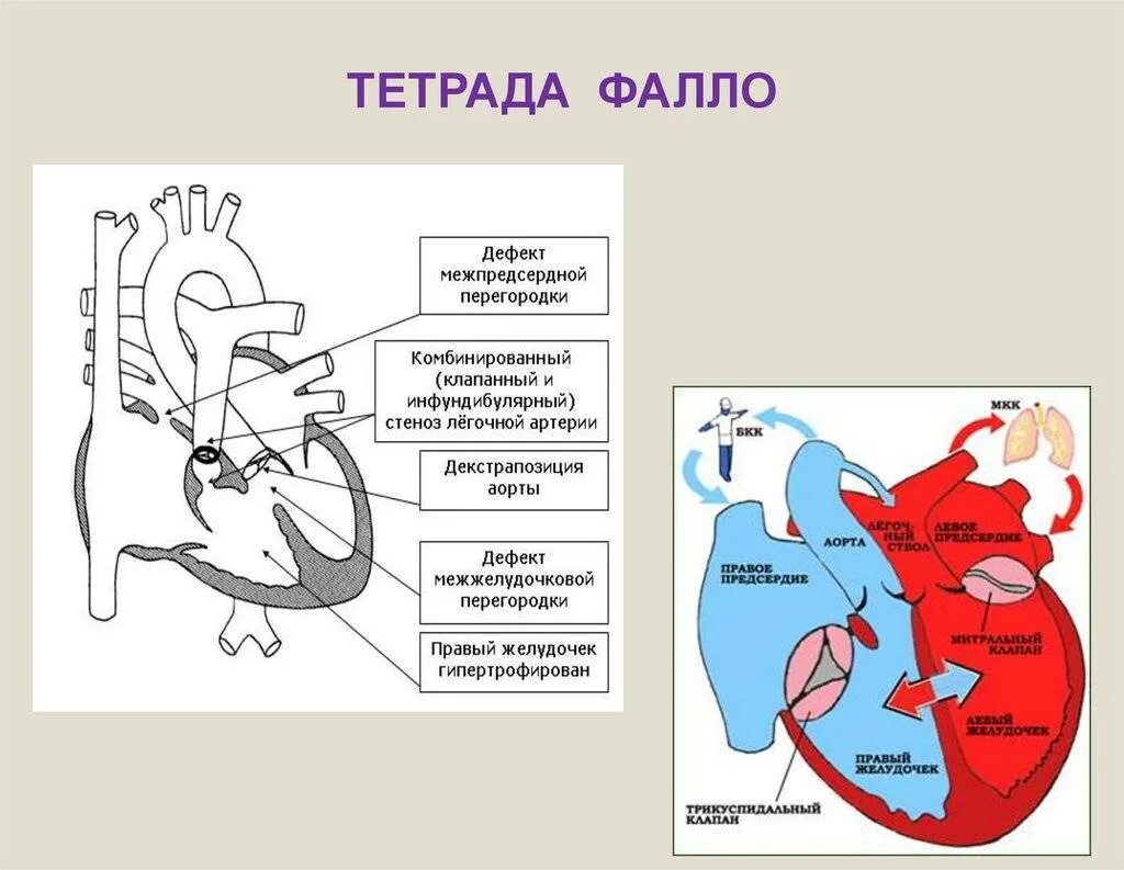 Впс дмжп у детей. Тетрада фалло у детей гемодинамика. порок сердца фалло у детей. схема сердца тетрада фалло. врожденные пороки сердца болезнь фалло.