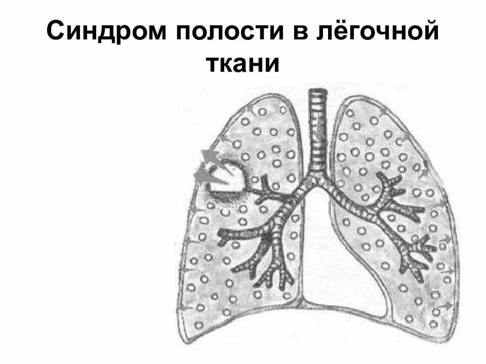Синдром полости в легком. Синдром полости в лёгком пропедевтика. синдром образования полости в легком пропедевтика. синдром полости в легочной ткани. синдром полости в легком пропедевтика внутренних болезней.