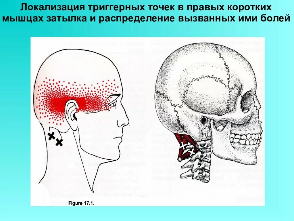 Боли в шее у основания черепа