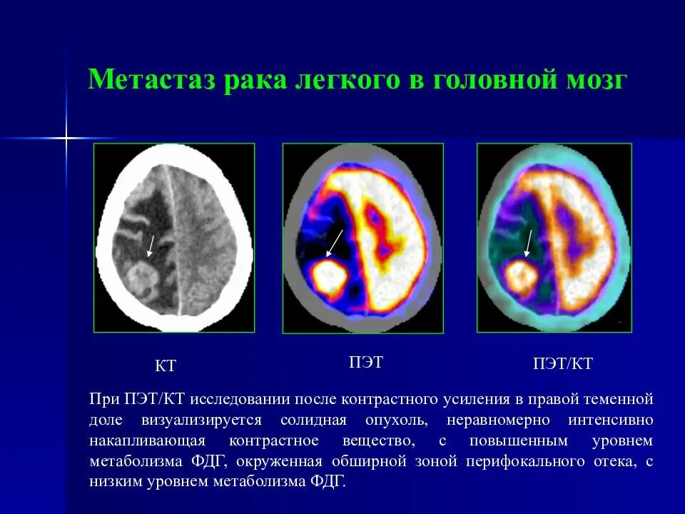 Метастазы головного мозга кт кт. ПЭТ кт опухоли головного мозга. Диагноз опухоли головного