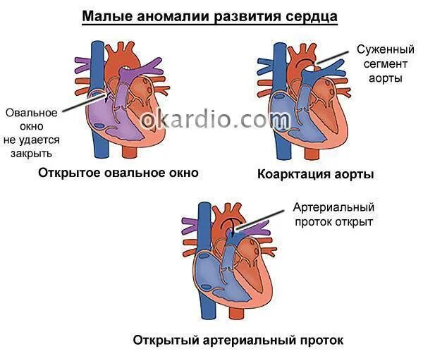 1 3 окно в сердце. Малые аномалии развития сердца. Аномалии развития сердца анатомия. Пороки развития сердца анатомия. Малые аномалии развития сердца у детей.
