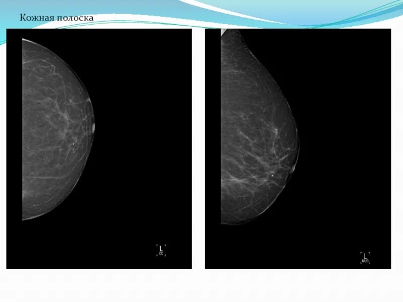 Инволютивные изменения молочных желез по узи. Фиброзно-жировая инволюция молочных желез рентген. Инволютивный фон молочных желез. Фиброзно-жировая инволюция рентген. Инволютивный тип молочных желез.