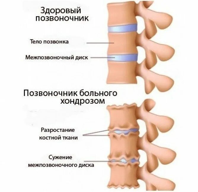 Хондроз ощущения. Хондроз поясничного отдела позвоночника симптомы лечение. спондилёз поясничного отдела позвоночника что это такое. дисплазия пояснично-крестцового отдела. остеохондроз грудного и поясничного отдела.