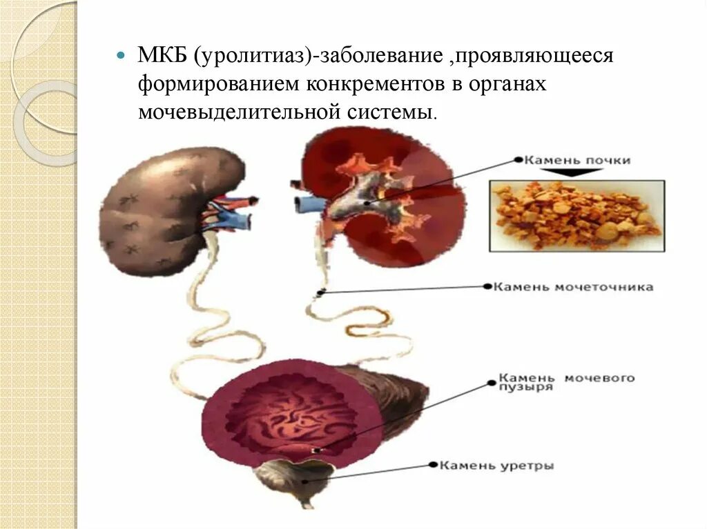 Мкб камни почек код мкб 10. Мкб-10 мочекаменная болезнь почечная колика. Мкб 10 мочекаменная болезнь почки камни. Почечнокаменная болезнь мкб.