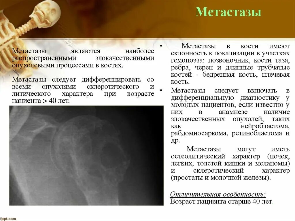 Метастатические опухоли костей. Метастазы опухоли костей. Опухоли метастазирующие в кость. Метастазы в кости рентгенодиагностика. Прогноз жизни при метастазах