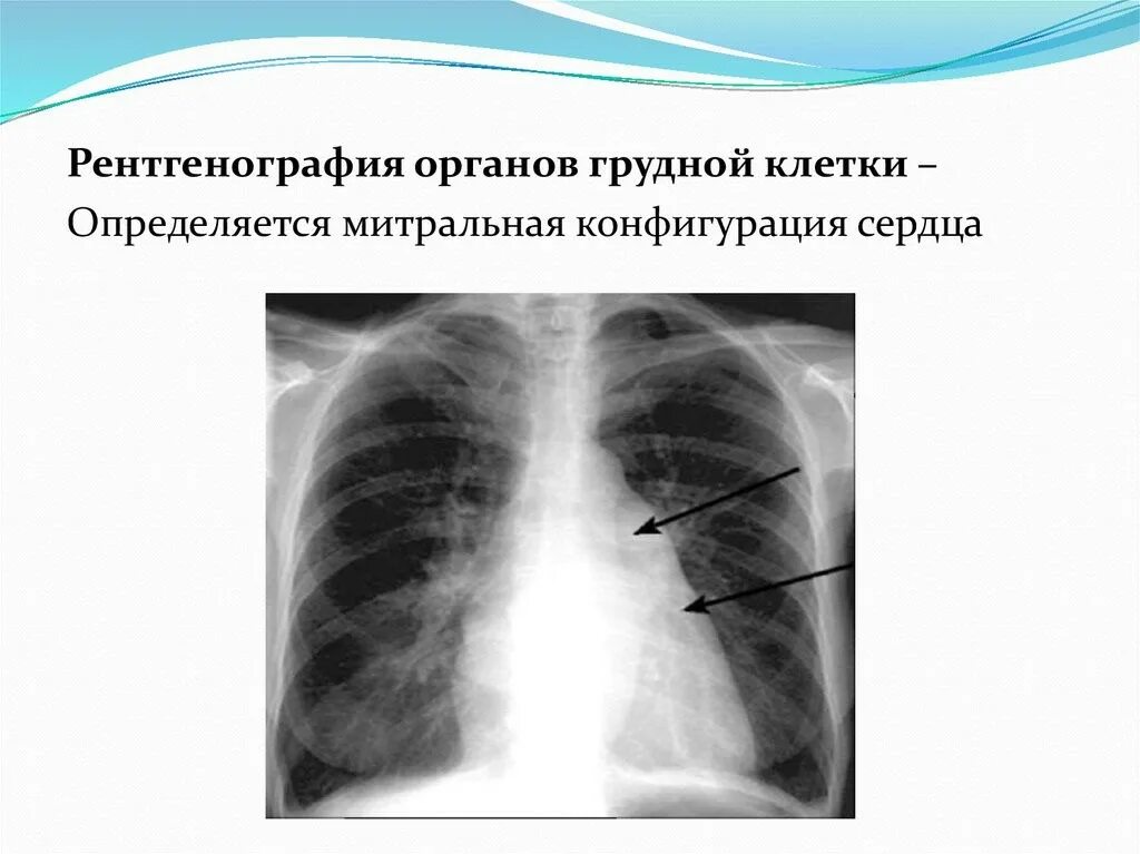 Рентгенограмма грудной клетки в косой проекции. Митральный стеноз рентгенография сердца. Стеноз грудной клетки. Рентгенография органов грудной клетки при аортальном стенозе. Аортальный стеноз рентген.