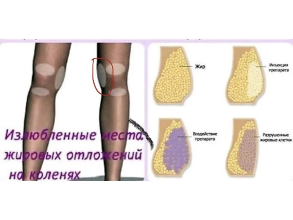 Липолитики схема. Сосудистый этап в мезотерапии для липолитиков схема. Липолитики инъекции в живот. Проблемные зоны тела у женщин. Липолитики схема.
