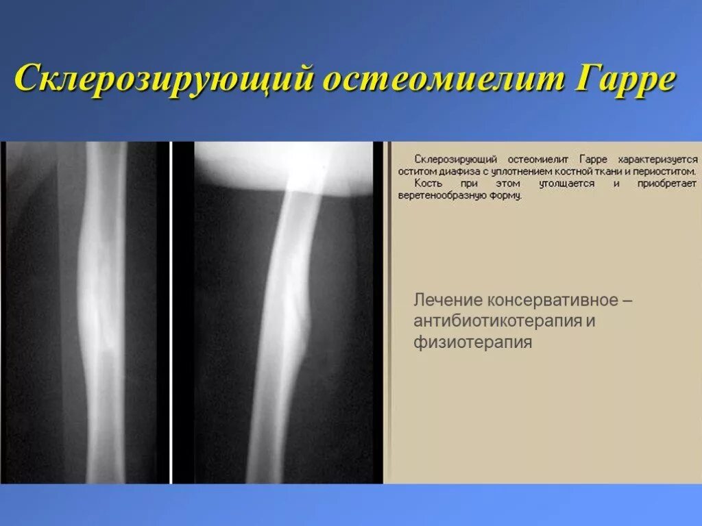 Хронический остеомиелит большеберцовой кости кт. Остеомиелит большеберцовой кости кт. Хронический остеомиелит большеберцовой кости рентген. Остеомиелит Олье рентген. Гнойные заболевания костей