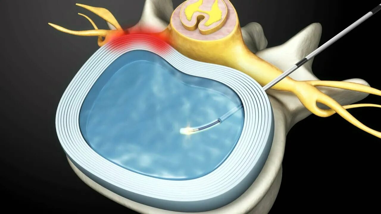 Нуклеопластика межпозвонкового диска холодноплазменная. Нуклеопластика грыжи позвоночника. Лазерная вапоризация грыжи позвоночника. Лазерная вапоризация грыжи межпозвоночного диска. Грыжа лазерная операция