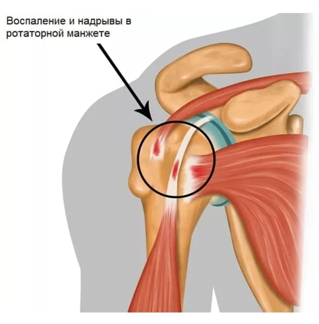 Сильная боль в плечевом суставе