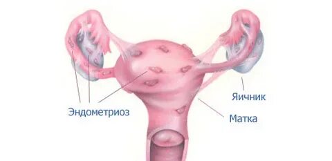 Эндометриоз после месячных