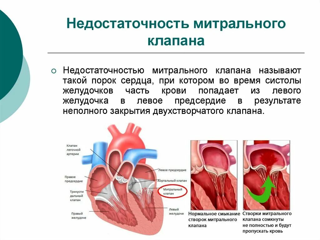 Недостаточность митрального клапана 1. Строение митрального клапана сердца. Недостаточность митрального клапана 1 степени. При недостаточности митрального клапана. Сердечная недостаточность митрального клапана