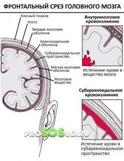 Субарахноидальное кровоизлияние головного
