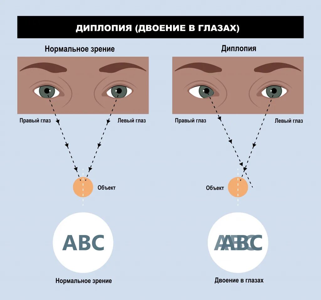 Монокулярная диплопия. Lbgkgbz. Бинокулярная дипломия.