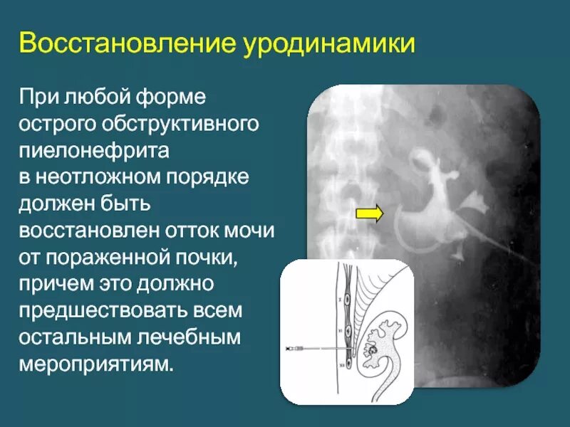 Необструктивный хронический пиелонефрит связанный. Необструктивный пиелонефрит. Острый обструктивный пиелонефрит. Хронический обструктивный пиелонефрит. Обструктивный пиелонефрит симптомы.