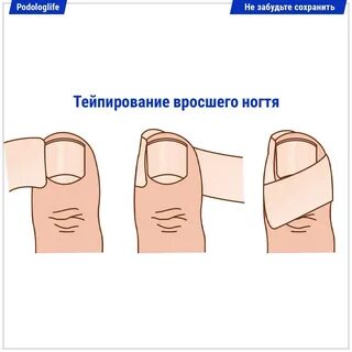 Тейпирование вросшего ногтя