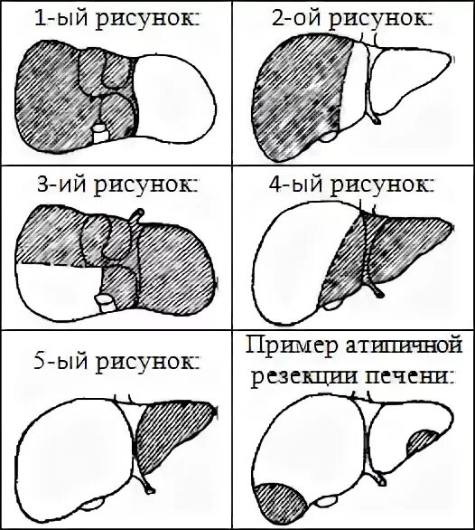 Операция резекция печени. Лобэктомия – резекция доли печени;. Клиновидная резекция печени. Атипичная краевая резекция печени.