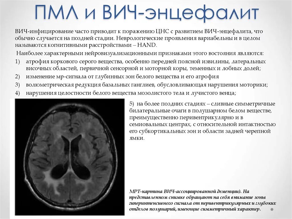 Спид клиническая картина. Вич ассоциированная деменция презентация. Вич-ассоциированная деменция. Вич ассоциированная алопеция. Вич ассоциированная энцефалопатия.