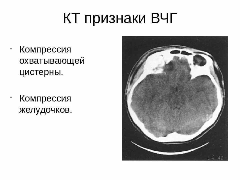 Внутричерепная гипертензия на кт. Кт признаки внутричерепной гипертензии. Признаки ВЧГ. Признаки ВЧГ на кт.