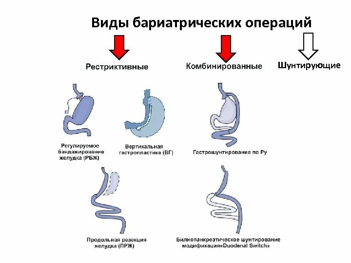 Бариатрическая хирургия это. Схема питания после бариатрической операции. Гастрошунтирование желудка схема операции. Бариатрическая операция на желудке хирургия.