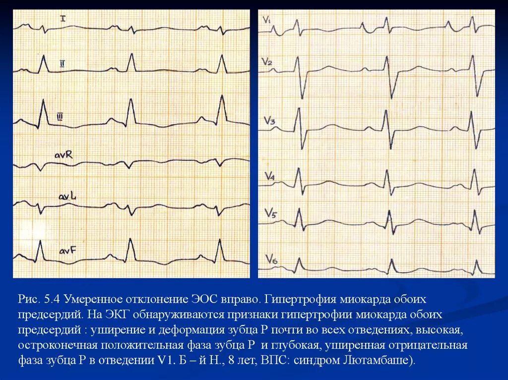 Гипертрофия левого предсердия на ЭКГ. Отклонение Эл оси вправо ЭКГ. Признаки отклонения ЭОС вправо на ЭКГ. Отклонение от оси сердца вправо на ЭКГ. Сердце отклонено вправо