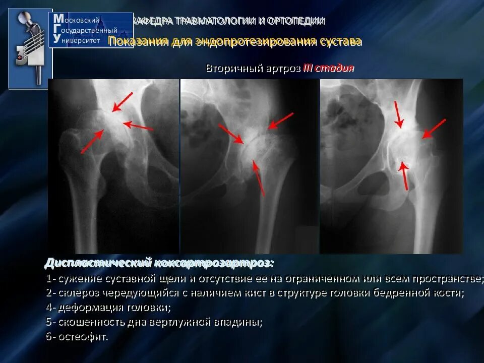 Инвалидность после эндопротезирования. Плазмоцитома тазобедренного сустава. Эндопротезирование тазобедренного сустава. После эндопротезирования тазобедренного сустава. Гемиартропластика тазобедренного сустава.