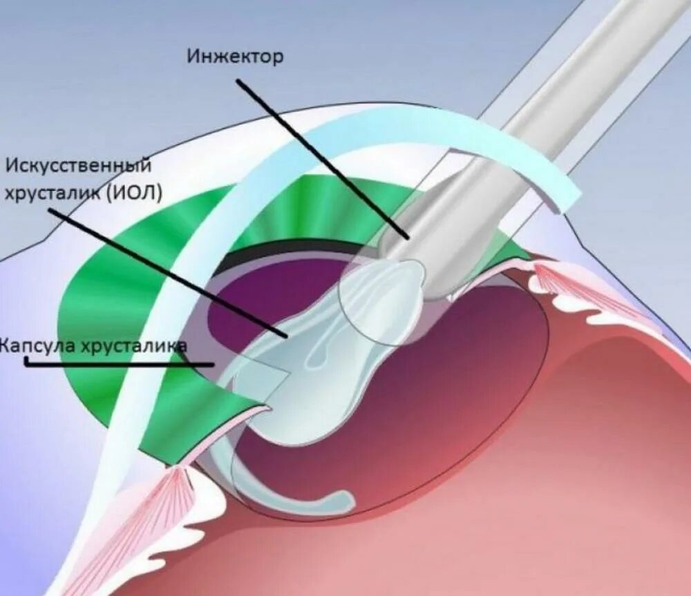 Что нельзя делать при замене хрусталика глаза. Катаракта факоэмульсификация. Ультразвуковая факоэмульсификация катаракты этапы. Мультифокальные интраокулярные линзы ИОЛ.