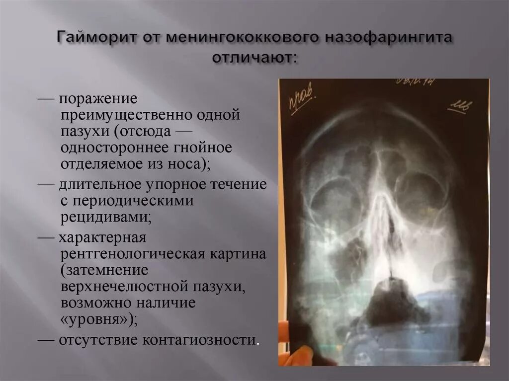 Ринофарингит назофарингит эпифарингит риноназофарингит лечение. Менингококковый назофарингит. менигококковый назофранигит. гнойный синусит и гайморит отличия. отсутствующий признак при менингококковом назофарингите.