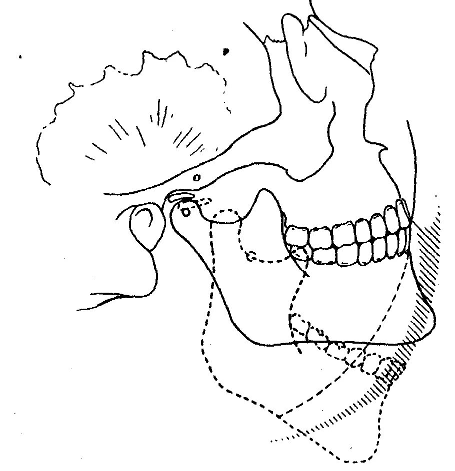 Подвижное соединение челюстей. Биомеханика нижней челюсти. Биомеханика движений нижней челюсти. Биомеханика ВНЧС.
