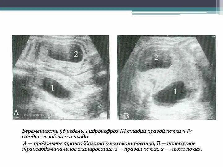 Почки у плода 20 недель. Агенезия почки у плода на УЗИ. Гидронефроз почки УЗИ.