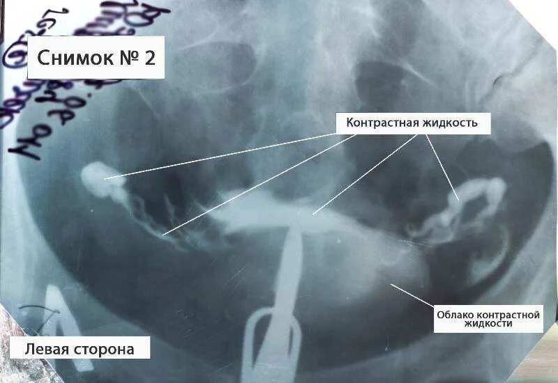 Забеременела при непроходимости труб. Рентгенографическое исследование проходимости маточных труб. Рентген снимки маточных труб. Непроходимость маточных труб УЗИ. Гидросонография маточных труб.