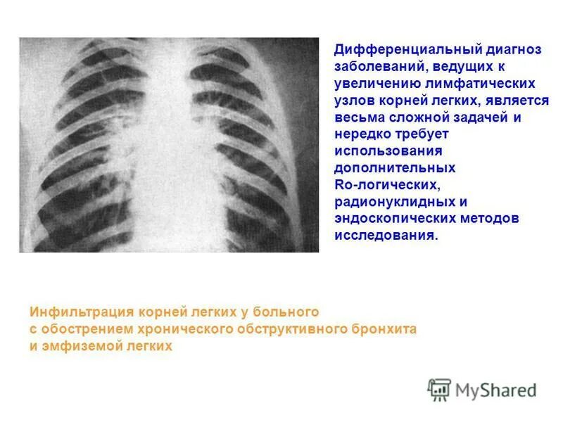 Увеличение корень легкого. Корень легкого инфильтрирован. Увеличение корня легкого. Корень легкого рентген.