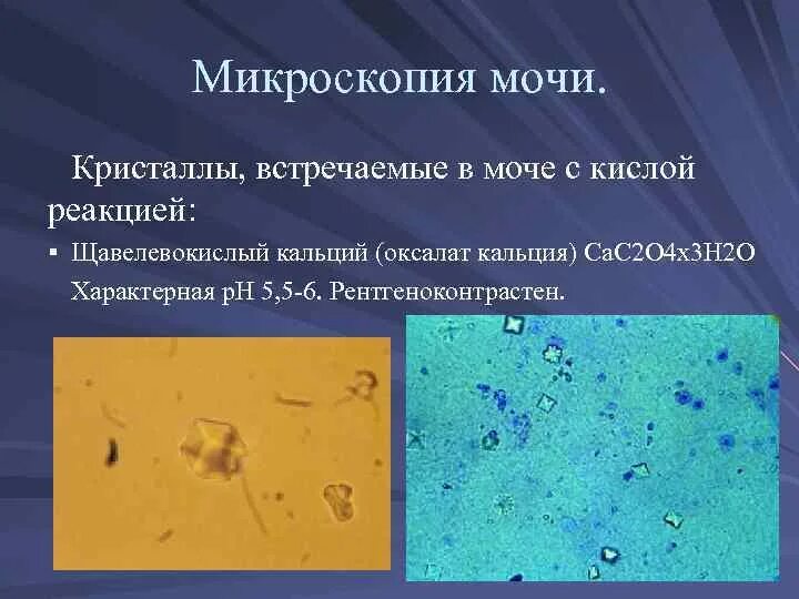 Оксалаты кальция в моче у мужчин. Оксалаты кальция в моче микроскопия. Мочекаменная болезнь микроскопия. Микроскопия мочи Кристаллы. Кристаллы в моче микроскопия.