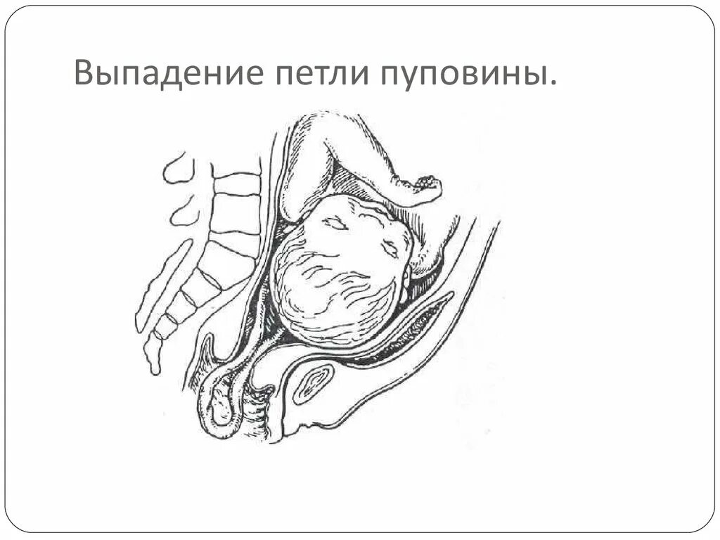 После прокола пузыря начинаются роды. Выпадение петель пуповины и мелких частей плода. Выпадение петли пуповины в родах. Выпедение петле пупавина.