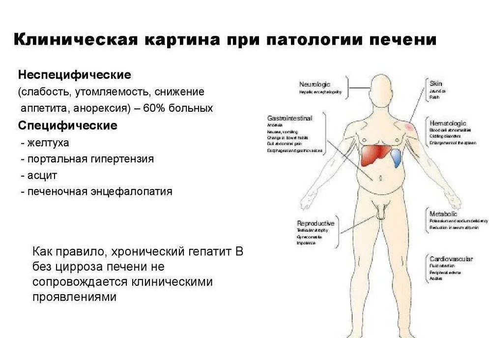 Первые проявления заболеваний. Клинические симптомы цирроза печени. Как понять что болит печень. Синдромы в клинической картине циррозов печени. Проблемы с печенью симптомы у женщин.