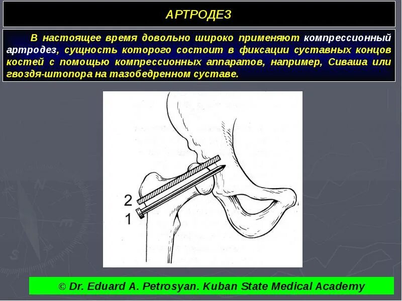 Артродез тазобедренного сустава. Артротест тазобедренного сустава. Артродез тазобедренного сустава показания. Компрессионный артродез коленного сустава. Артродез суставов операция