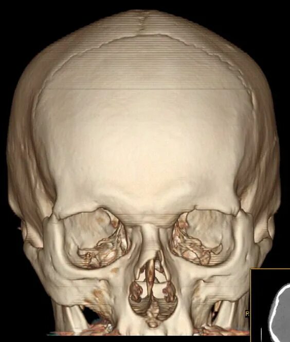 Остеопороз костей черепа на кт. Гиперостоз костей черепа мрт. Кт 3d снимок костей черепа Красноярск.