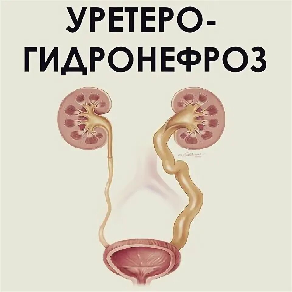 Гидронефроз симптомы у взрослых. Гидронефроз и уретерогидронефроз. врожденный уретерогидронефроз.
