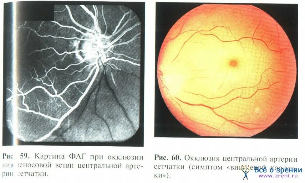 Окклюзия центральной артерии сетчатки клиника. Эмболия центральной артерии сетчатки глаза. Тромбоз ЦВС глазное дно. Глазное дно тромбоз артерии. Передняя ишемическая нейропатия