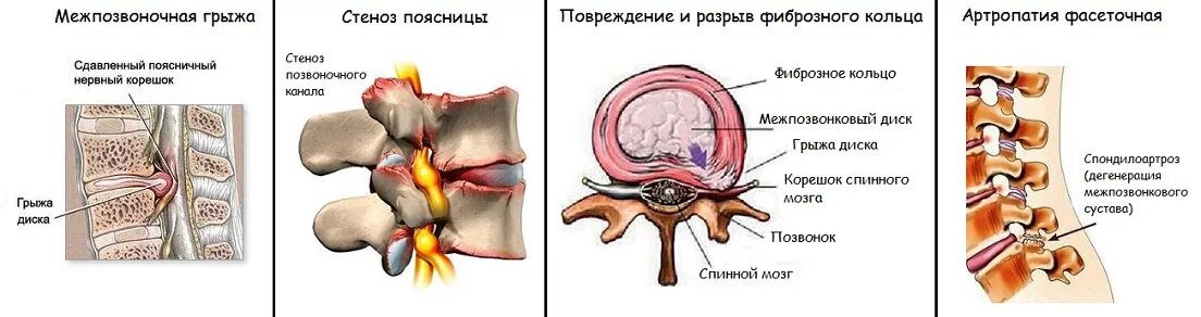 Удаления грыжи позвоночника поясничного отдела отзывы. Грыжа позвоночника поясничного отдела у собак. Грыжа позвоночного диска. Межпозвонковая грыжа симптомы. Межпозвонковая грыжа патогенез.