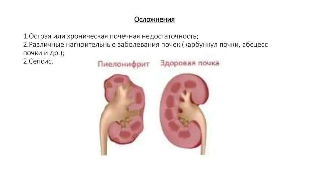 Патология почек, почечная недостаточность. Мочекаменная болезнь хронический пиелонефрит. Острая почечная недостаточность и мочекаменная болезнь. Острая и хроническая почечная недостаточность осложнения. Осложненный пиелонефрит