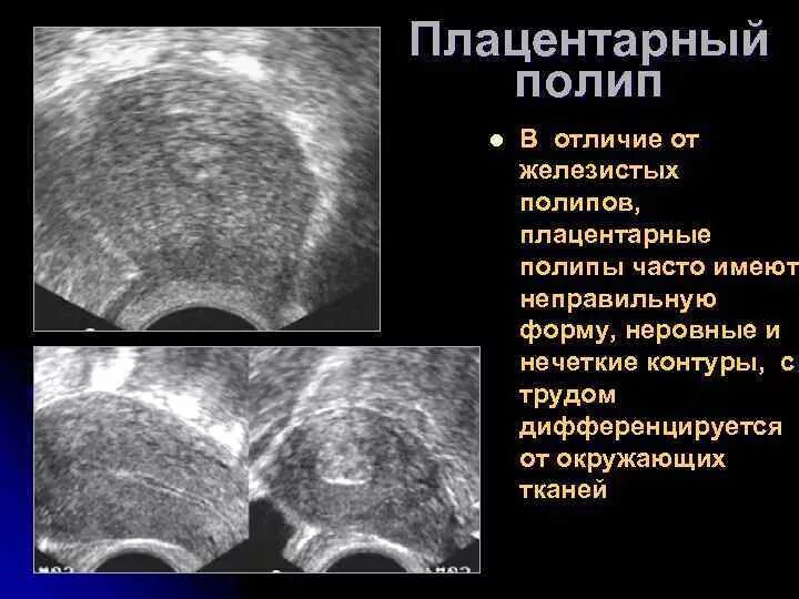 Можно забеременеть с полипом в матке. Хориальный полип эндометрия. Плацентарный полип патанатомия.