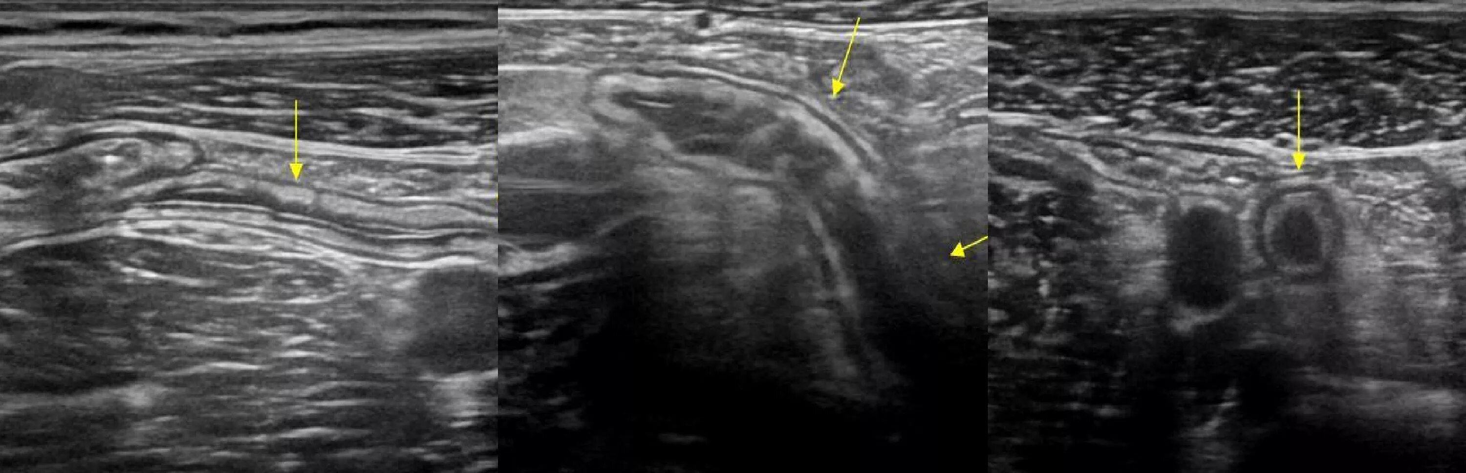УЗИ червеобразного отростка. Флегмонозный аппендицит УЗИ. Аппендикулярный отросток на УЗИ. Воспаленный аппендикс на УЗИ. На узи видно воспаление