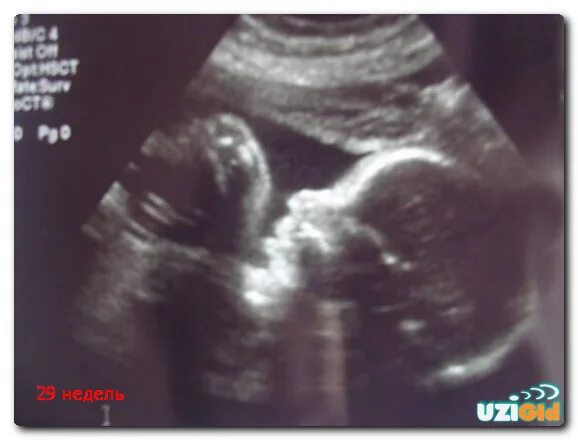 29 Недель беременности фото УЗИ плода. 26 Неделя беременности УЗИ мальчик. УЗИ на 29 неделе беременности. УЗИ ребенка 30 недель беременности.