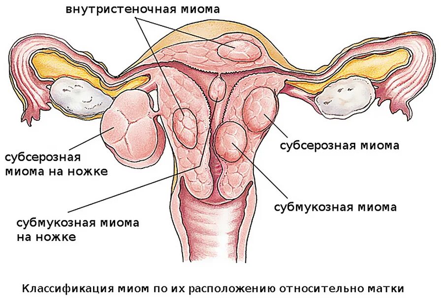 Субмукозная миома матки классификация. Миома интерстициальная субсерозная что это. Интрамурально субсерозная миома матки субмукозная.