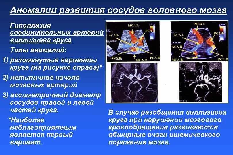 Аномалии сосудов головного мозга. Аномалии развития сосудов головного мозга. Аномалии развития артерий головного мозга. Порок сосудов головного мозга что это такое. Гипоплазия правой артерии головного мозга